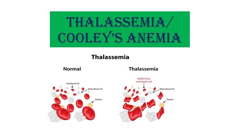beta thalassemia anemia|Beta Thalassemia (Cooley's Anemia) .